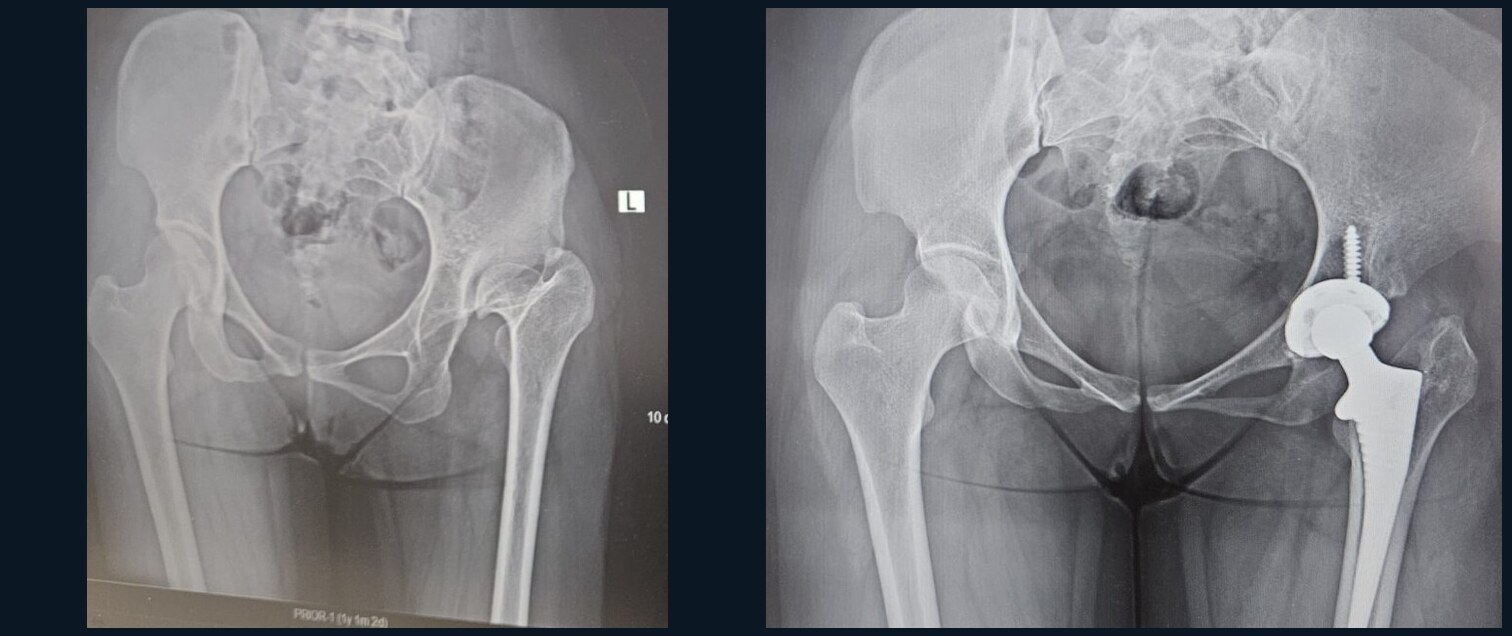 Radiološki prikaz složene anatomije kuka prije i nakon ugradnje endoproteze